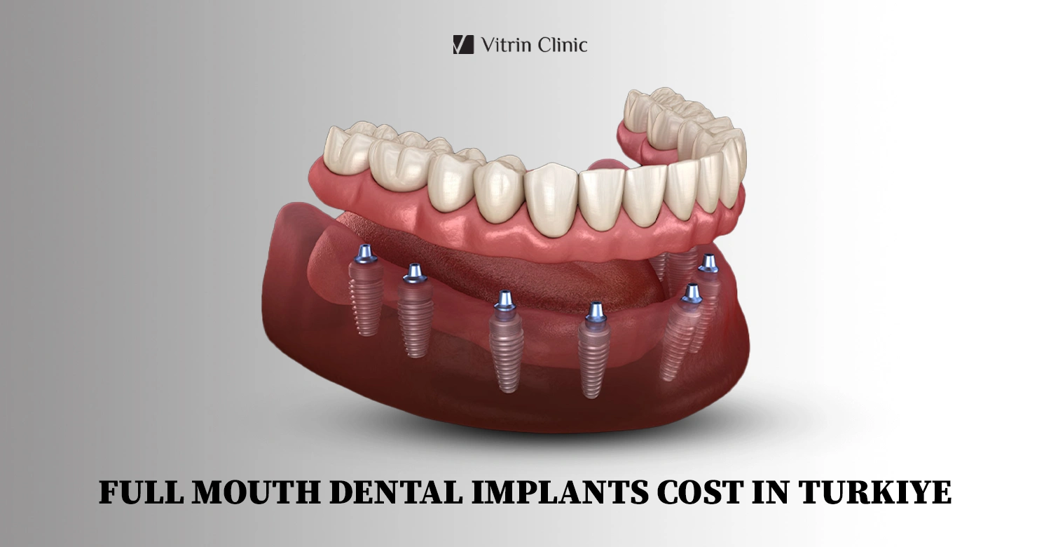 implant dentaire complet