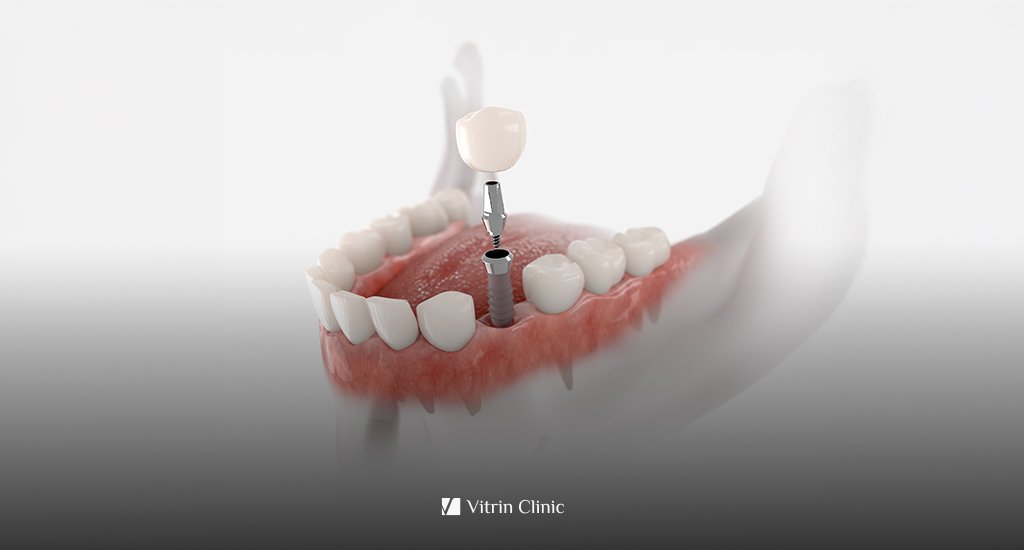 d'Implants Dentaires