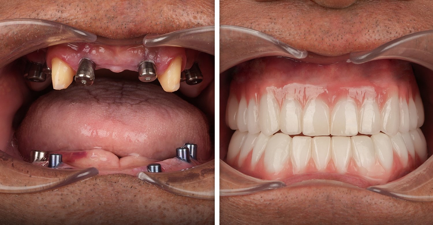 Implantes dentales All on 4 en Turquía: procedimiento, precios y por qué elegir la Clínica Vitrin