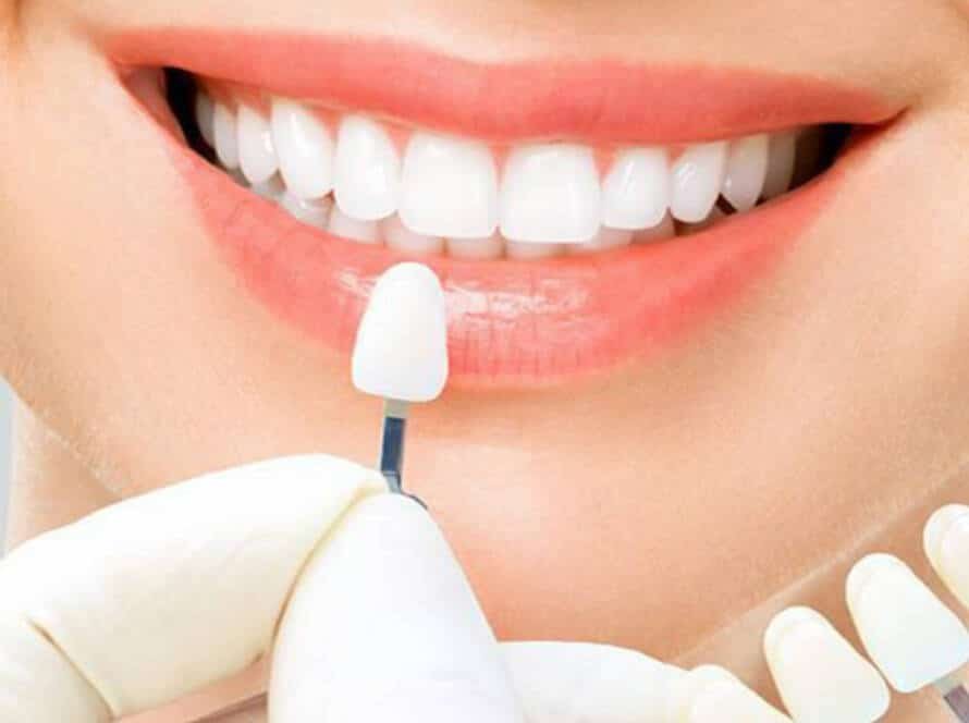 Cost of Veneers in Turkey 2025 A Comprehensive Guide by Vitrin Clinic