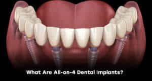 What Are All-on-4 Dental Implants